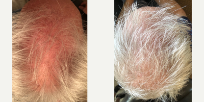 PRP for Hair Loss before and after photo