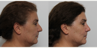 Rhinoplasty before and after photo