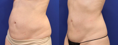 CoolSculpting before and after photo