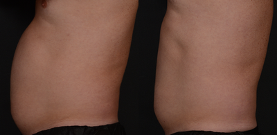 Emsculpt before and after photo