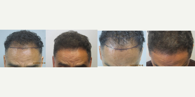 Hair Transplant before and after photo