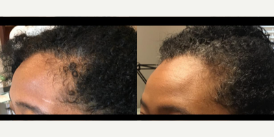 PRP for Hair Loss before and after photo