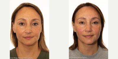 Rhinoplasty before and after photo