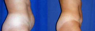 Tummy Tuck before and after photo