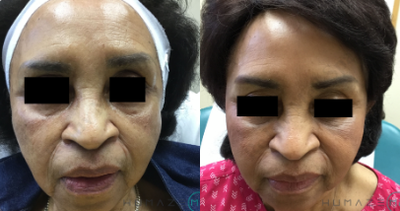 Vampire Facelift before and after photo