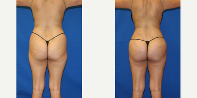 Brazilian Butt Lift before and after photo