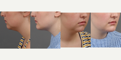 Chin Liposuction before and after photo