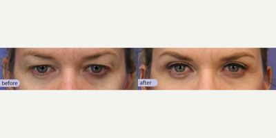 Eyelid Surgery before and after photo
