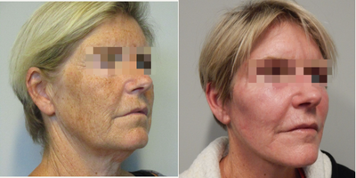 Facelift before and after photo