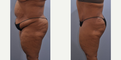 Tummy Tuck before and after photo