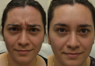 Botox before and after photo