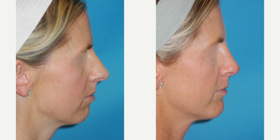 Chin Implant before and after photo