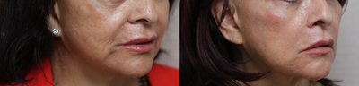 Dermal Fillers before and after photo