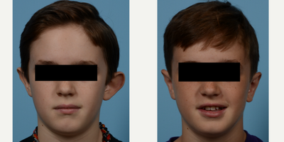 Ear Surgery before and after photo