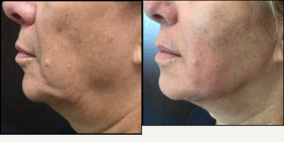 Juvederm before and after photo