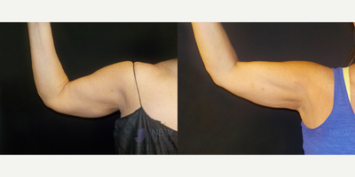 Laser Liposuction before and after photo