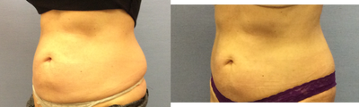 SculpSure before and after photo