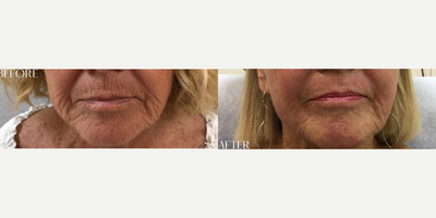 Skin Tightening before and after photo