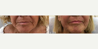 Skin Tightening before and after photo