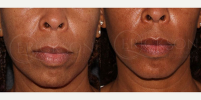 Voluma before and after photo
