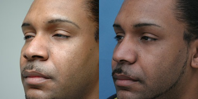 African American Rhinoplasty before and after photo