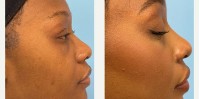 African American Rhinoplasty before and after photo