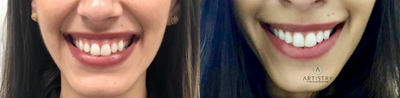 Botox for Gummy Smile before and after photo