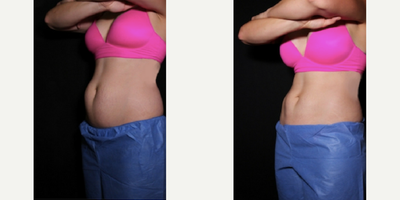 CoolSculpting before and after photo