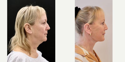 Deep Plane Facelift before and after photo