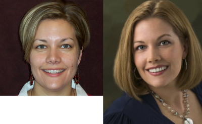 Porcelain Veneers before and after photo