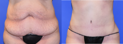 Tummy Tuck before and after photo