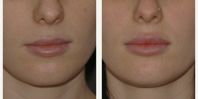 Dermal Fillers before and after photo