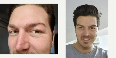Eyebrow Transplant before and after photo