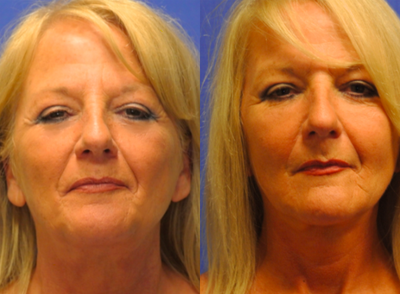 Facelift before and after photo