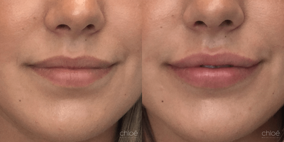 Lip Fillers before and after photo
