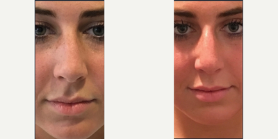 Nonsurgical Nose Job before and after photo