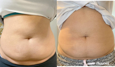 SculpSure before and after photo