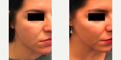 Voluma before and after photo