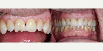 Dental Crown before and after photo