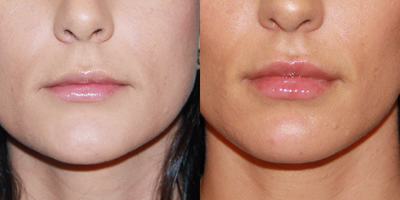 Juvederm before and after photo