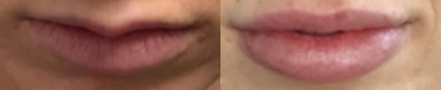 Restylane before and after photo