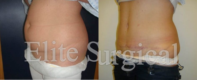 Tummy Tuck before and after photo