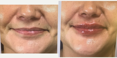 Volbella before and after photo