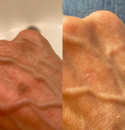 IPL before and after photo