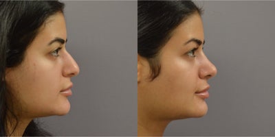 Rhinoplasty before and after photo