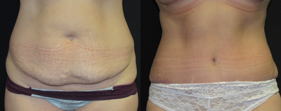 Tummy Tuck before and after photo