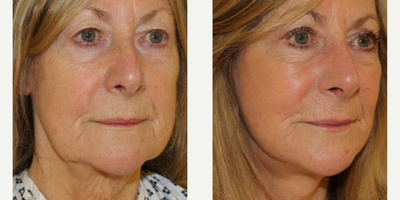 Facelift before and after photo