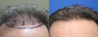 FUE Hair Transplant before and after photo
