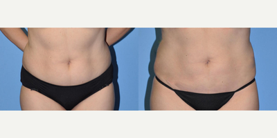 Liposuction before and after photo