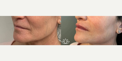 Restylane Kysse before and after photo